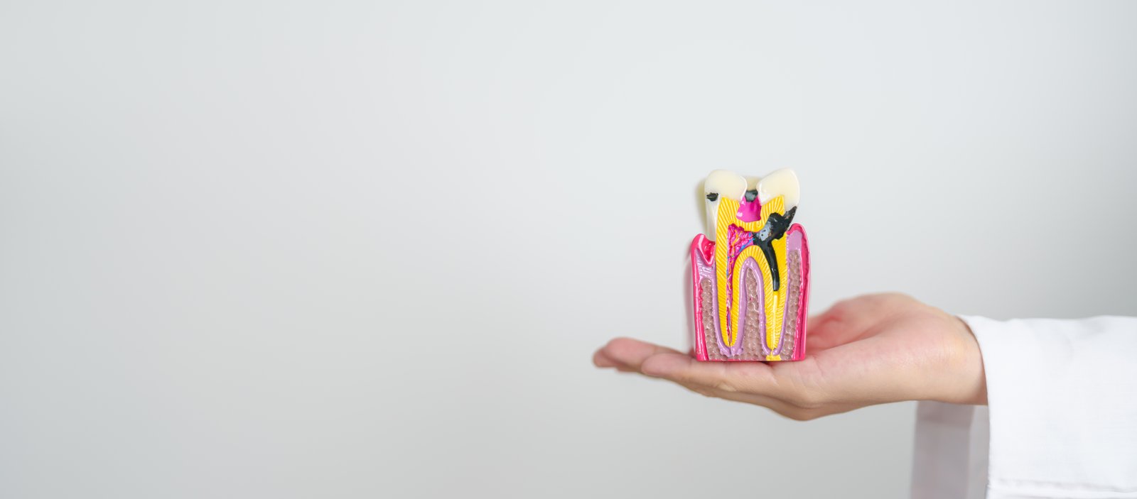 Root Canal Treatment