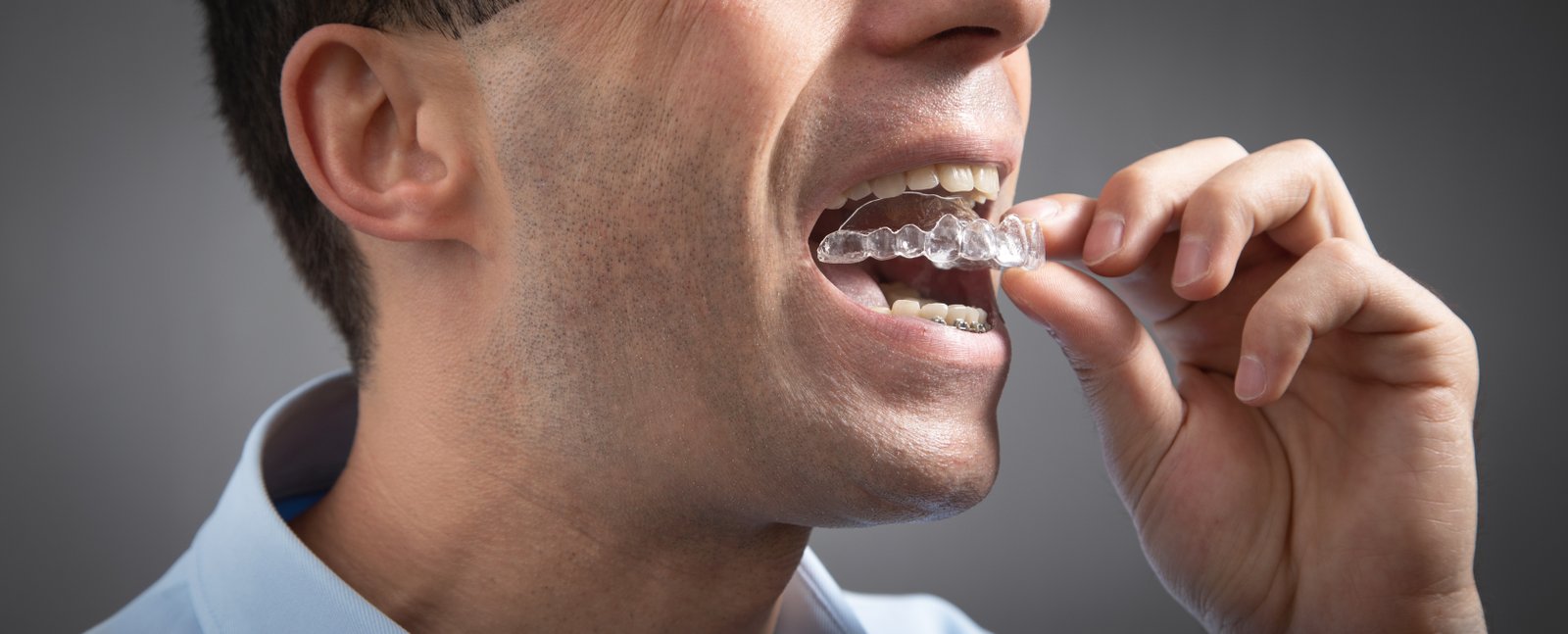 Invisible Aligners